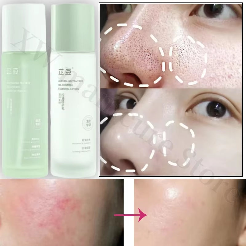 Tea Tree Essence Set Oil Control Acne Removal Skin Soothing Hydrating Oily Skin Care Unisex Water Lotion Two-Piece Set Skin Care